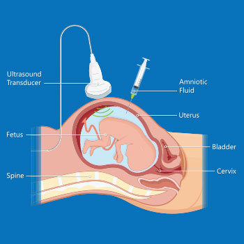 Medical illustration showing amniocentesis procedure where a small amount of amniotic fluid is collected using ultrasound guidance for genetic testing