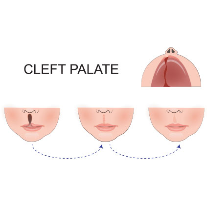 Medical illustration showing cleft lip and cleft palate in infants for diagnosis and treatment reference