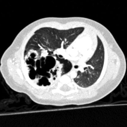 CT scan showing congenital cystic adenomatoid malformation (CCAM) with multiple cystic lesions in the fetal lung