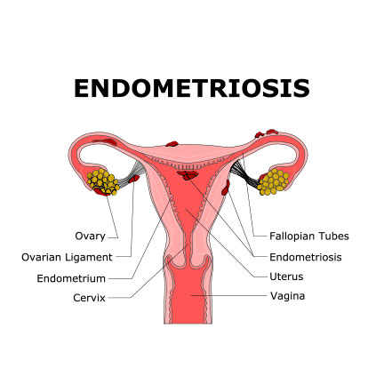 Medical illustration of uterus showing endometriosis affecting ovaries, fallopian tubes, and uterine lining