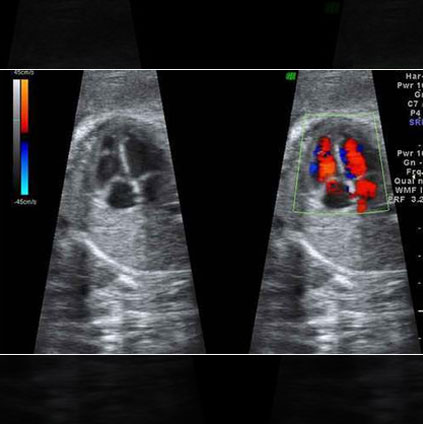 Fetal echocardiography ultrasound showing detailed color Doppler view of the baby’s heart to detect cardiac abnormalities during pregnancy