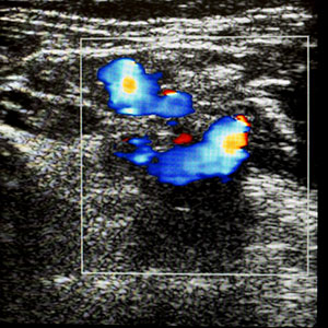 Ultrasound Doppler scan showing blood flow in fetal umbilical cord to monitor baby’s growth and placental circulation during pregnancy