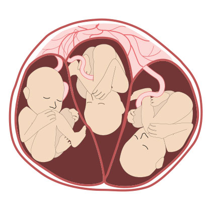 Illustration of multiple fetuses in the womb representing selective fetal reduction procedure in multifetal pregnancy