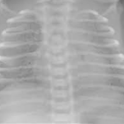 Chest X-ray showing hyaline membrane disease (HMD) with underdeveloped lungs in a premature newborn