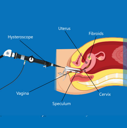 Medical illustration showing the hysteroscopy procedure where a thin telescope is inserted through the cervix into the uterus to examine and treat uterine conditions