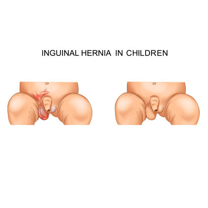 Medical illustration showing inguinal hernia in children with visible swelling in the groin region
