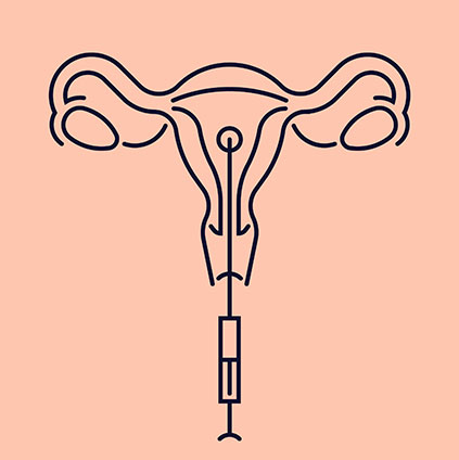 Illustration showing the intrauterine insemination (IUI) procedure where prepared sperm is placed into the uterus using a catheter to aid fertilization
