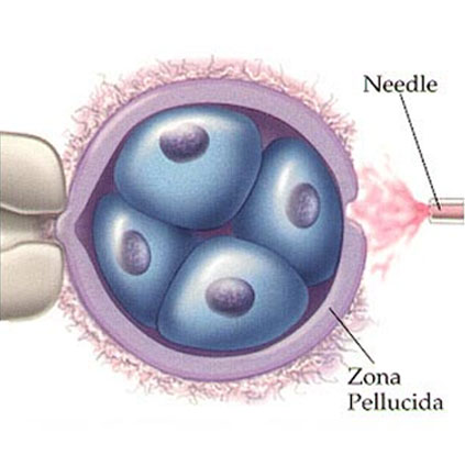 Microscopic illustration showing laser-assisted hatching where a precise laser creates a small opening in the embryo’s zona pellucida to aid implantation.