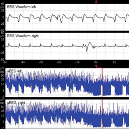 EEG brain wave patterns showing neonatal seizure activity for clinical diagnosis and monitoring