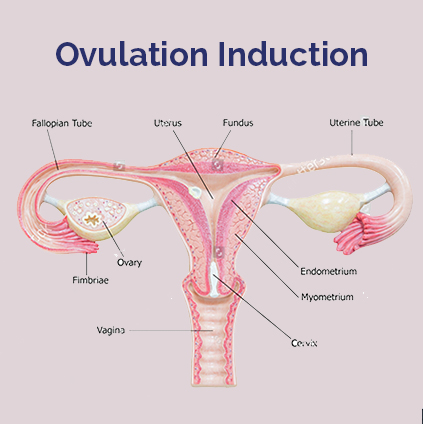 Medical diagram showing the female reproductive system labeled with uterus, ovaries, and fallopian tubes explaining ovulation induction process for fertility treatment.