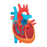 Medical illustration showing human heart with patent ductus arteriosus (PDA) connection between pulmonary artery and aorta