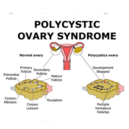 Medical illustration comparing normal ovary and polycystic ovary showing multiple immature follicles typical of PCOS condition