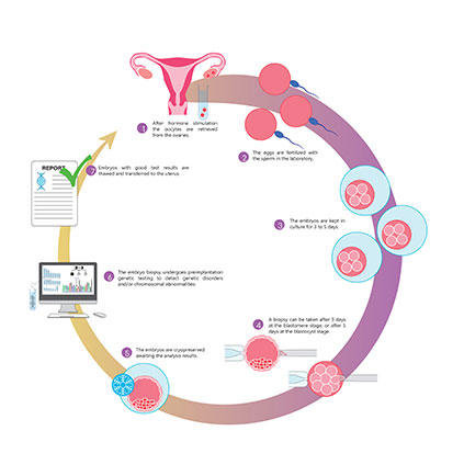 Diagram explaining Preimplantation Genetic Testing (PGT-A) process showing embryo biopsy and chromosomal screening before IVF transfer