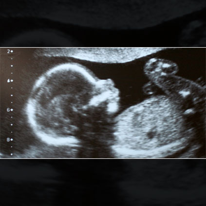 Ultrasound image from TIFFA scan showing fetal anatomy used to detect congenital abnormalities and monitor baby’s development during pregnancy