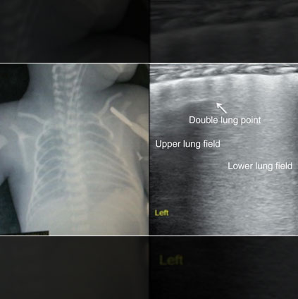 Chest X-ray showing signs of transient tachypnoea of the newborn (TTN) with lung fluid retention