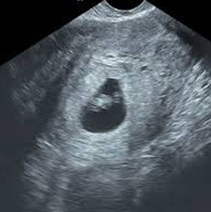 Ultrasound image showing nuchal translucency measurement during first trimester scan to detect chromosomal abnormalities in the fetus